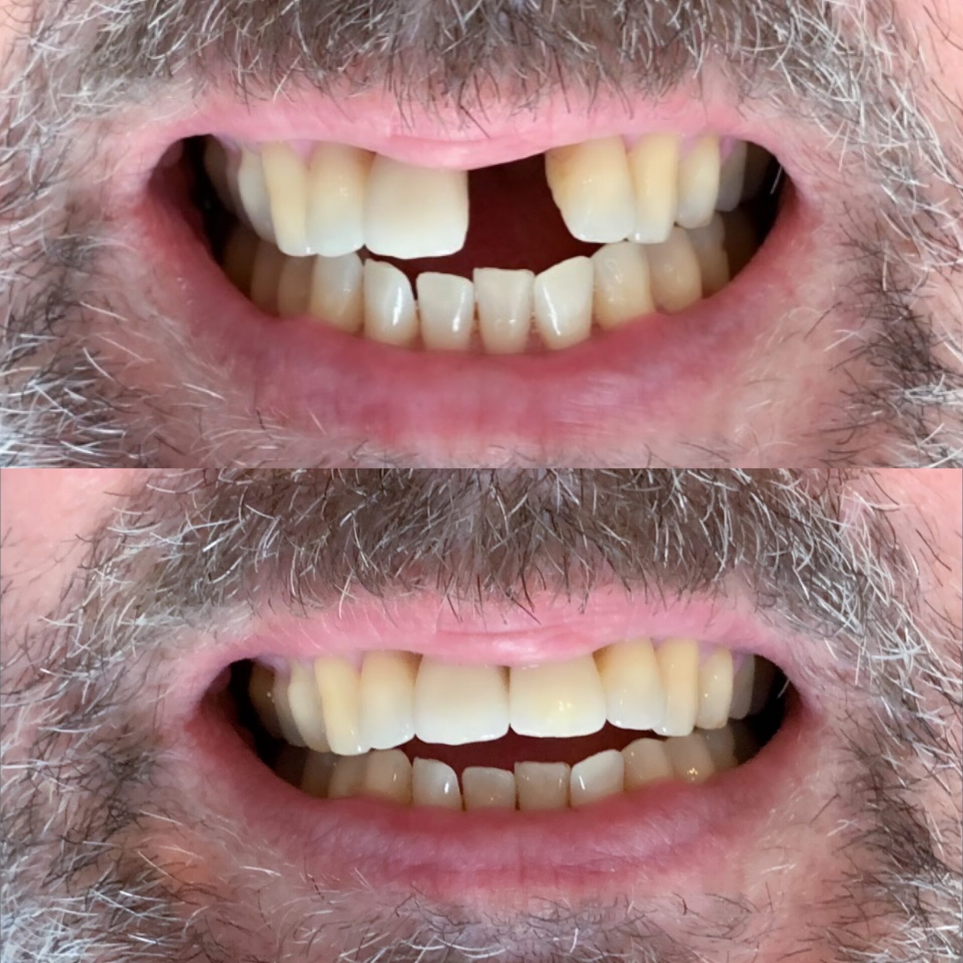 Implant before and after